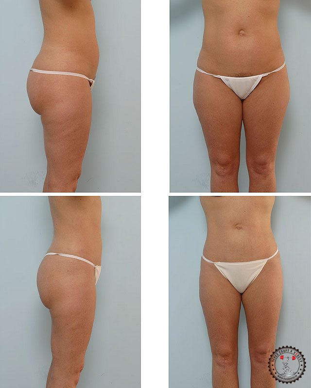 Липолитики для похудения - отзывы, фото до и после