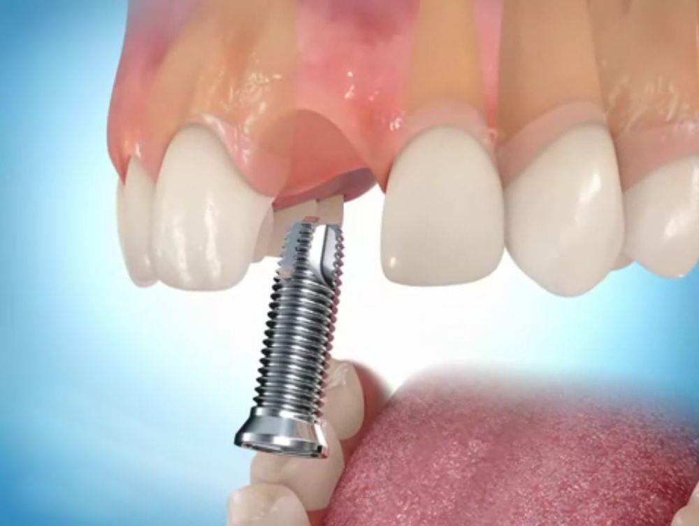 Зубной имплантант - что это такое? установка, цена и отзывы, все за и против
