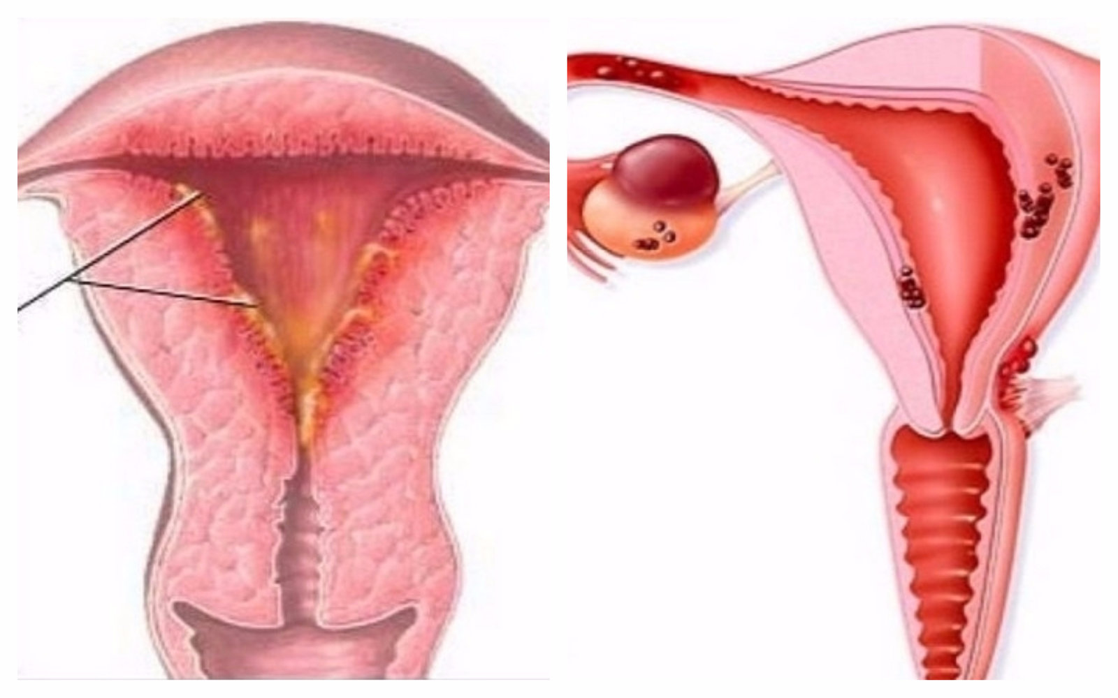 Признаки эндометриоза у женщин - симптомы, диагностика и лечение