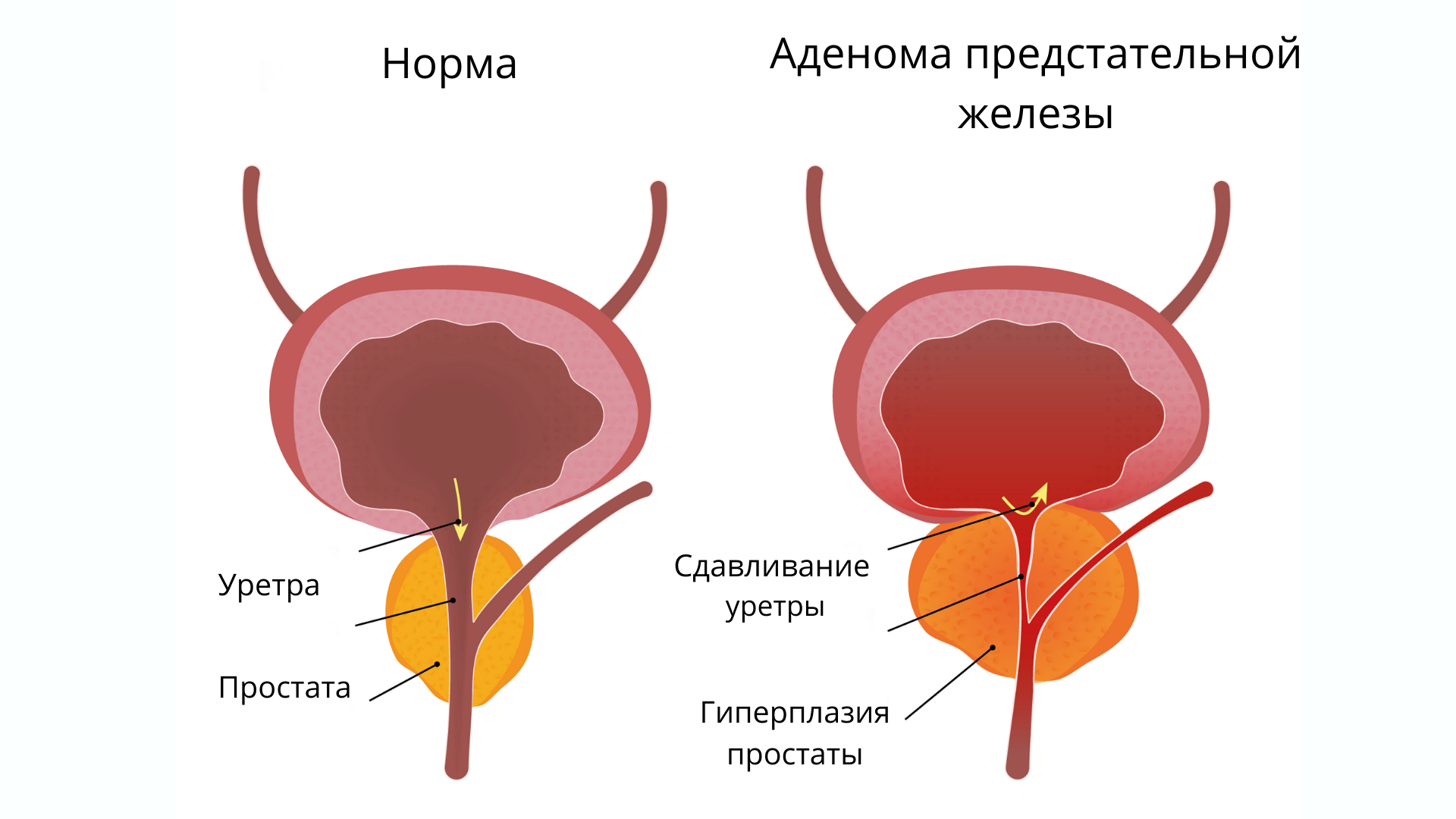Диагноз дгпж в урологии: что это, как диагностировать аденому простаты у мужчин после 40 лет, лечение | prostatitaid.ru