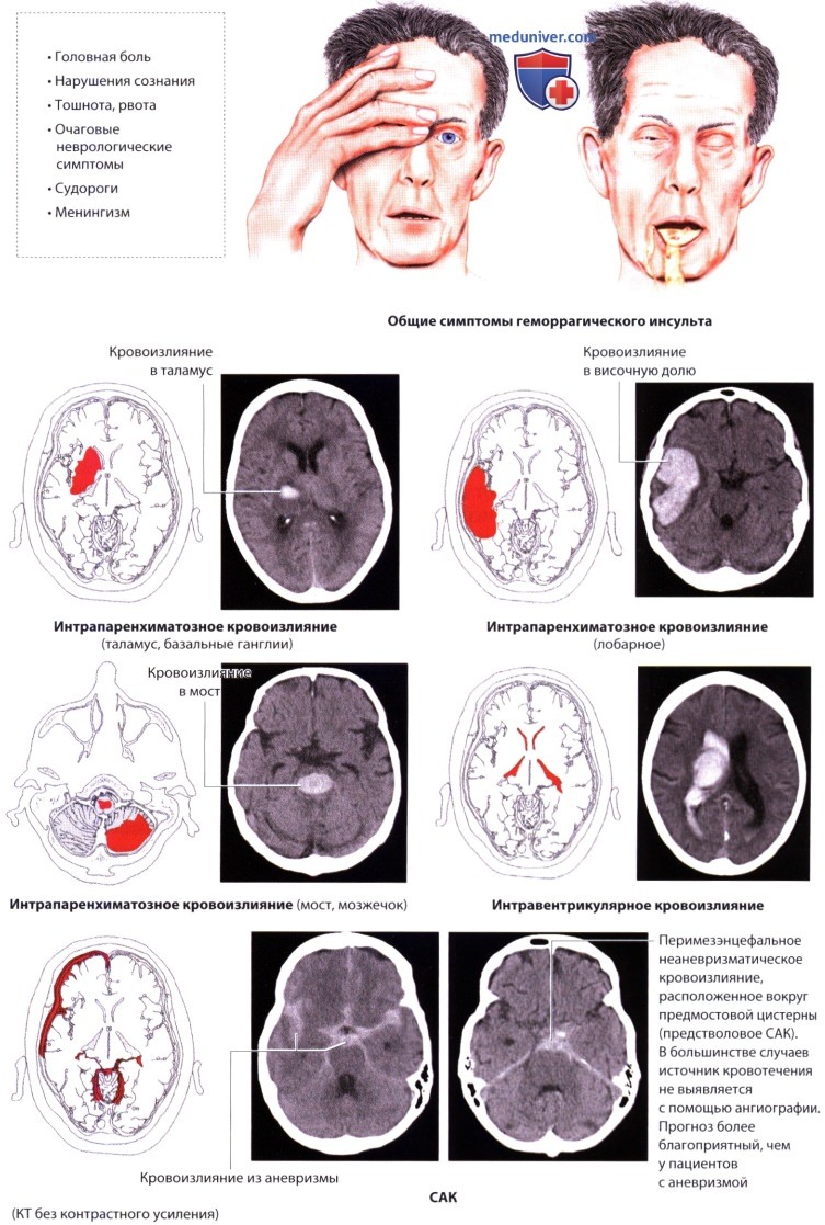 Поражение головного мозга при инсульте. Стволовой ишемический инсульт на кт. Ишемический или геморрагический инсульт на кт. Осложнения ишемического инсульта мозга. ОНМК геморрагический инсульт.