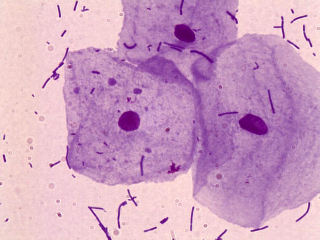 Клетки слизистой полости рта. Бактериальный вагиноз микроскопия мазка. Гинекологический мазок эпителий плоский. Лактобактерии палочки Дедерлейна. Кокко бацилярная Фоора.