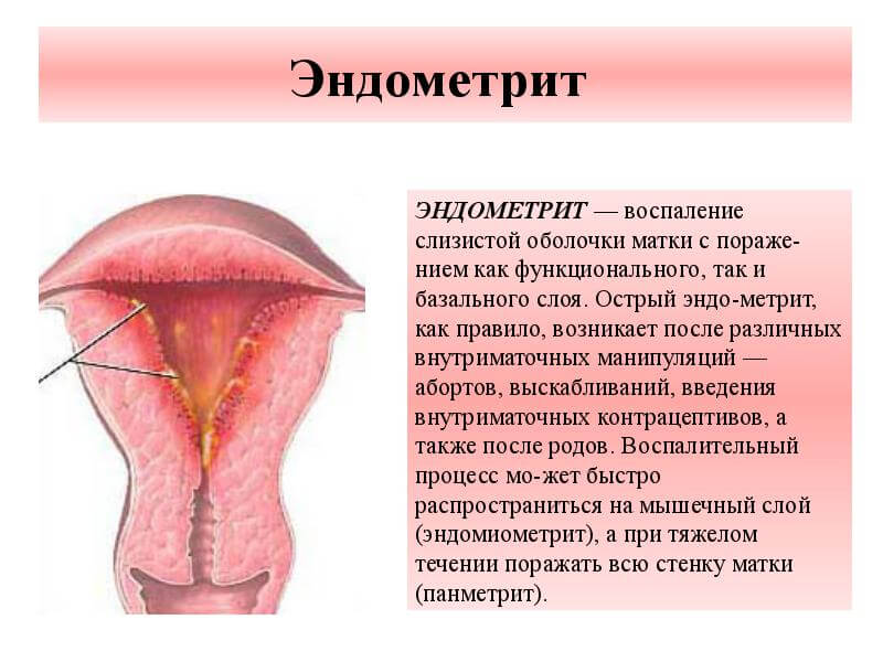 Эндометрит: симптомы и лечение у женщин — статья мцрм