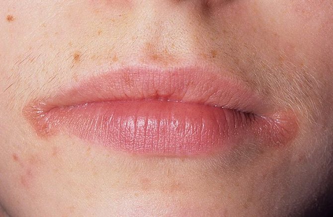 Что такое ангулит (хейлит, заеды) – причины и лечение болезни рта