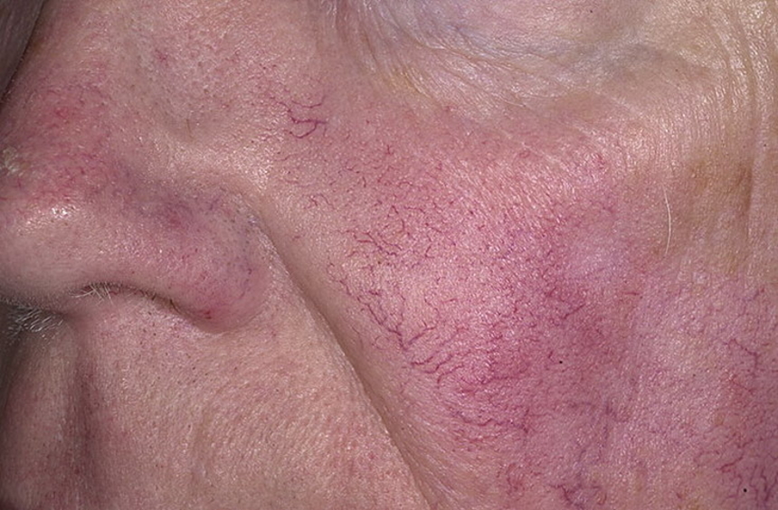 Что такое купероз кожи, важные особенности недуга
