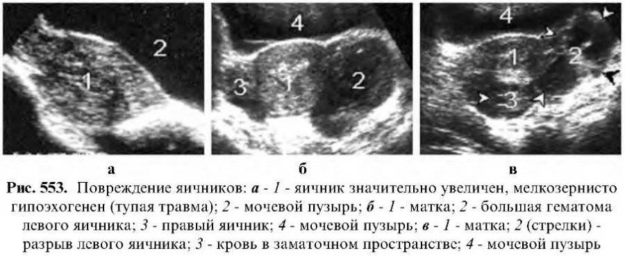 На узи желтое тело в яичнике: что это значит, как выглядит после овуляции и при беременности, если отсутствует, на какой день цикла определяется, нормы