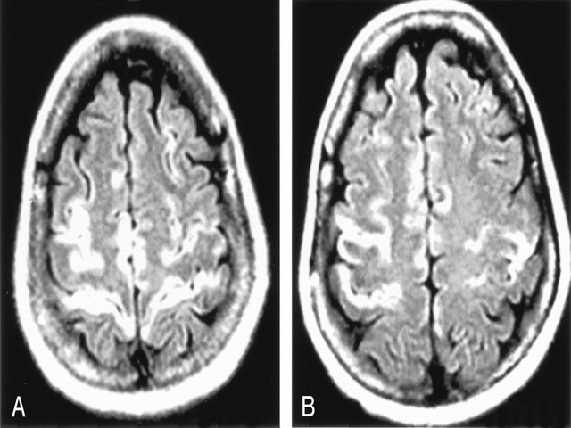 Виды энцефалопатии головного мозга: как лечить и что это такое ?