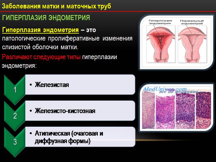 Гиперплазия шейки матки | симптомы и лечение гиперплазии шейки матки | компетентно о здоровье на ilive