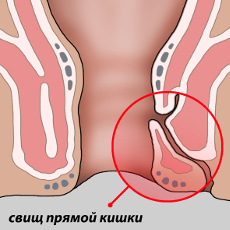 Парапроктит: симптомы, фото, лечение. операция при парапроктите