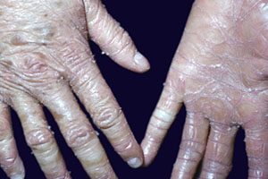 Ихтиоз кожи - причины, симптомы, лечение, виды и фото