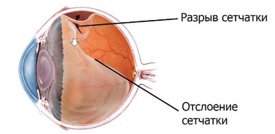 Сетчатка глаза: анатомия органа, симптомы, причины, лечение, профилактика и прогноз отслоения