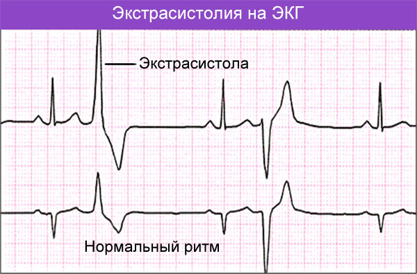 Аритмия сердца