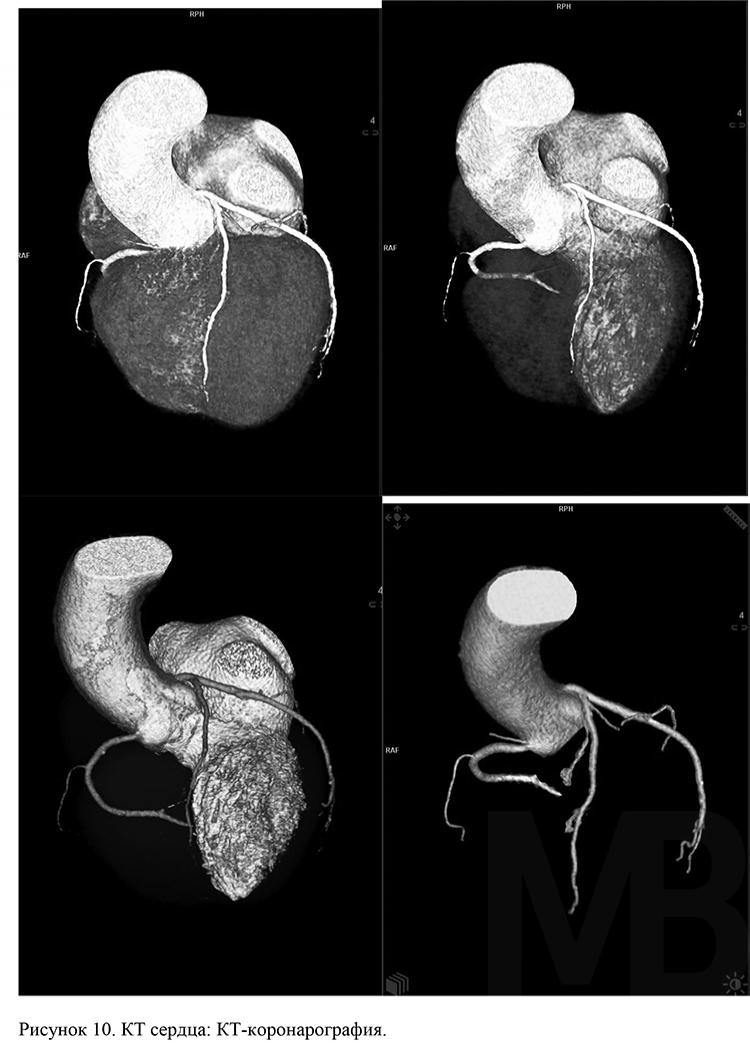 Кт-коронарография сосудов сердца: описание, исследования, показания и противопоказания, отзывы