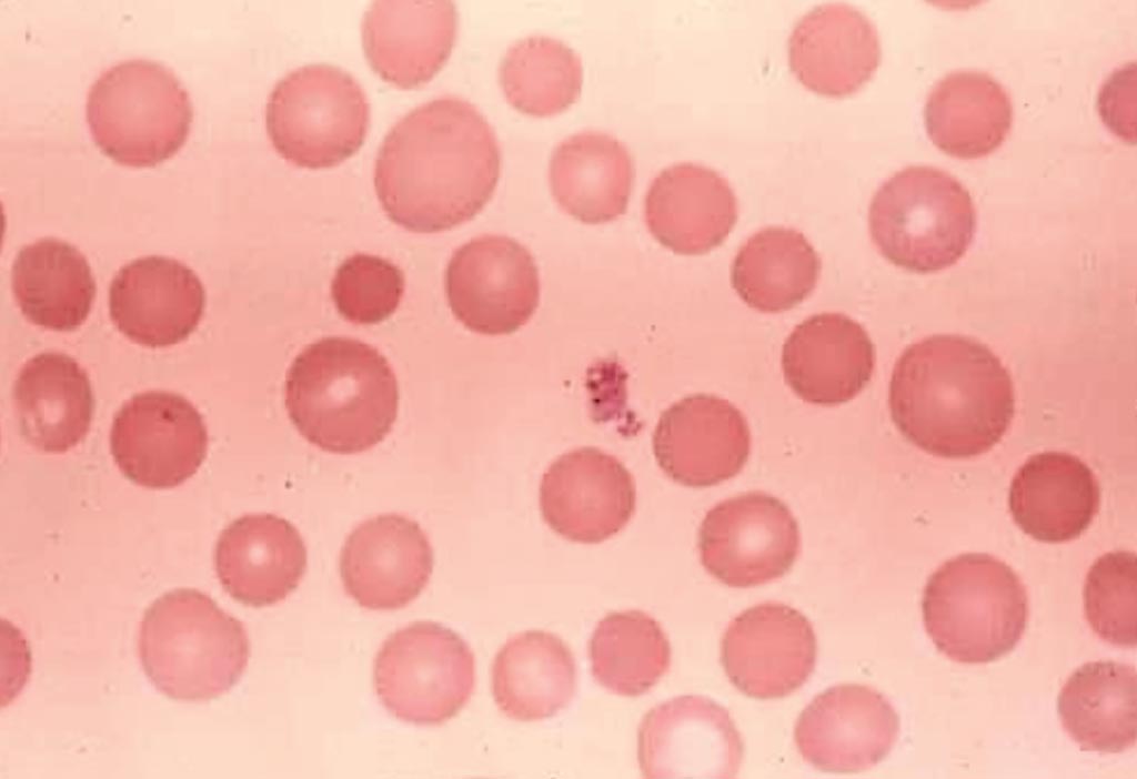 Анизоцитоз эритроцитов в общем анализе крови - причины, лечение