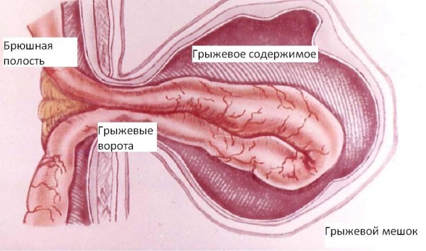 Симптомы, лечение и последствия паховой грыжи у мужчин