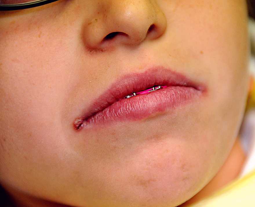 Заеды в уголках рта: причины, лечение, как вылечить заеды у взрослого и у ребенка