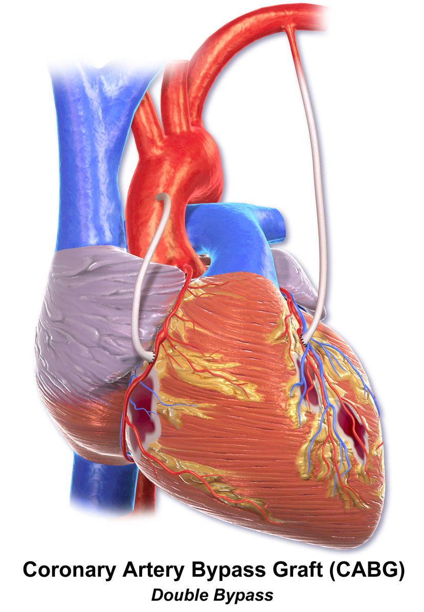 Правила жизни пациентов после операции на открытом сердце (операции коронарного шунтирования) | кардиологический центр в санкт-петербурге