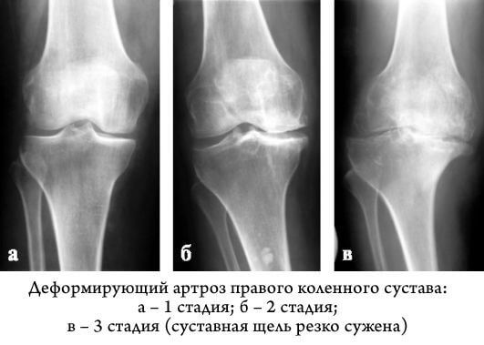 Гонартроз коленного сустава 1 степени: факты о болезни, возможность лечения
