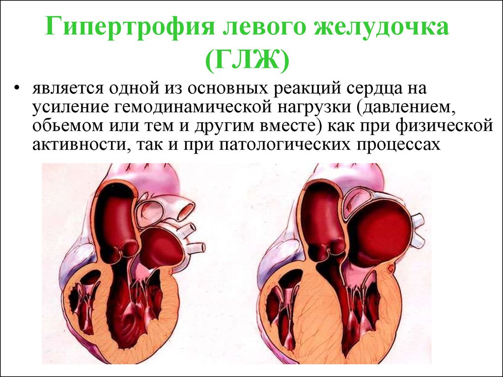 Гипертрофия левого желудочка сердца: лечение, причины, признаки
