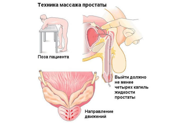 Полезен ли массаж простаты, техника выполнения