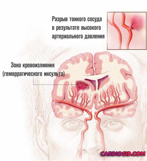 Ангиография сосудов головного мозга: виды, показания, противопоказания, подготовка и проведение процедуры
