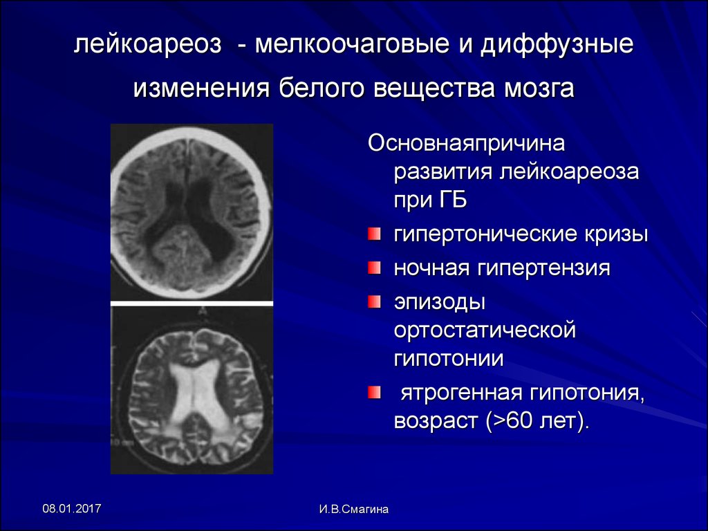 Лейкоареоз головного мозга: лечение, диагностика и стадии