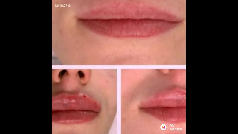 Тренды инъекционной косметологии: губы бантиком, профиль джоли