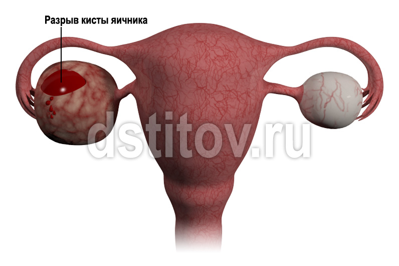 Апоплексия (разрыв) яичника: симптомы, лечение, последствия