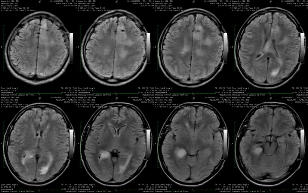 Глиобластома головного мозга: причины появления, лечение, степени