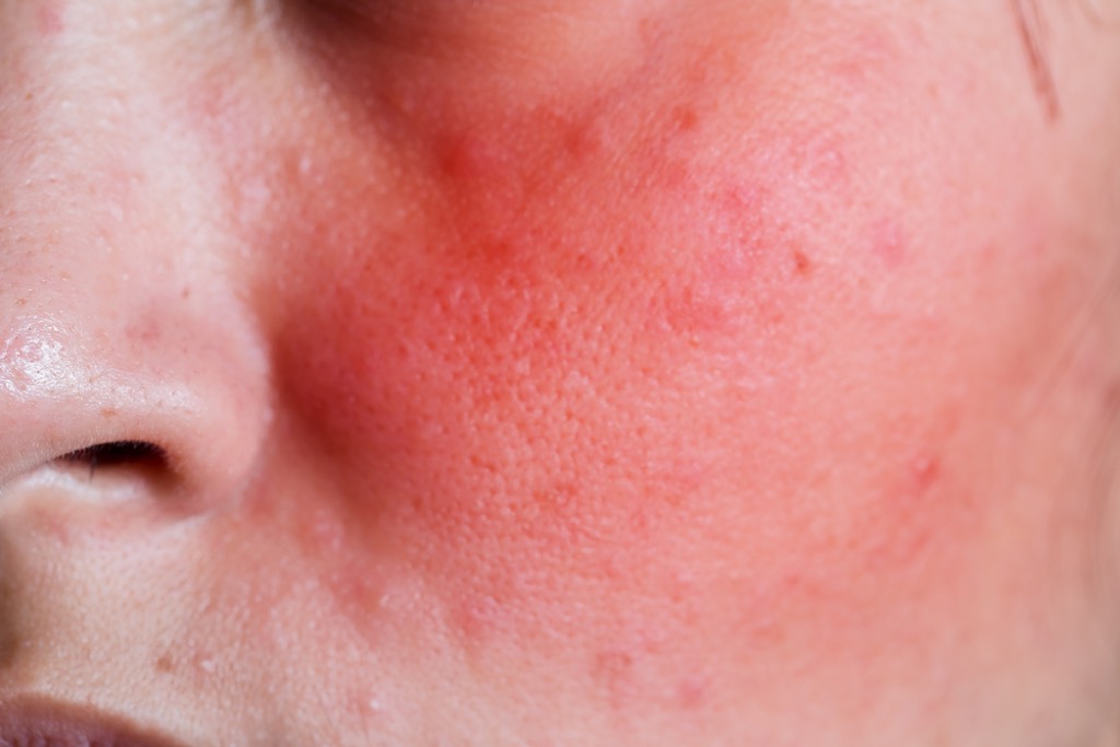 Гиперемия кожи лица: что это такое, фото, причины и лечение