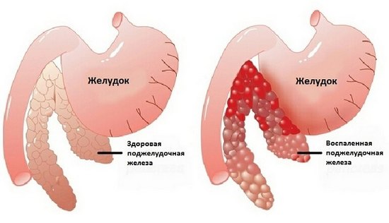 Панкреатит: симптомы воспаления поджелудочной железы и меры лечения
