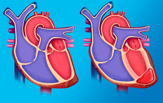Аневризма сердца: симптомы, диагностика, лечение. осложнения аневризмы сердца
