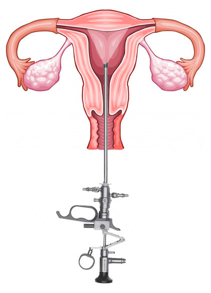 Цели гистерорезектоскопии полипа эндометрия