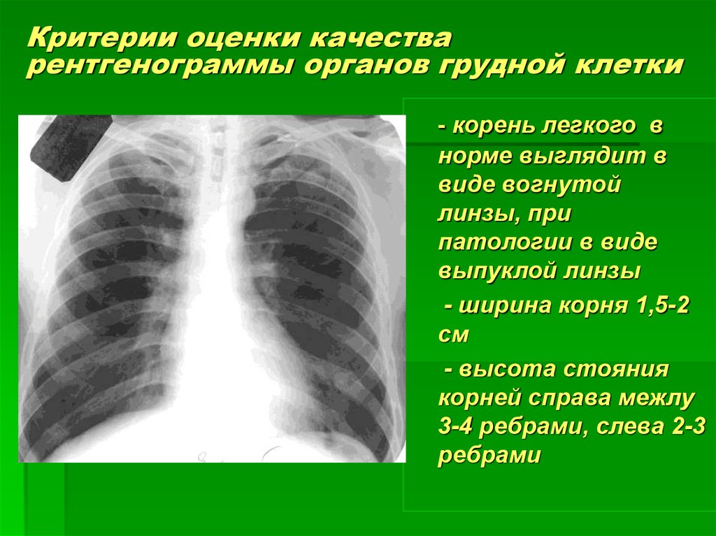 После рентгена можно делать флюорографию. Рентген органов грудной клетки норма и патология. Флюорография органов грудной клетки норма. Рентген легких норма. Рентген лёгких норма.