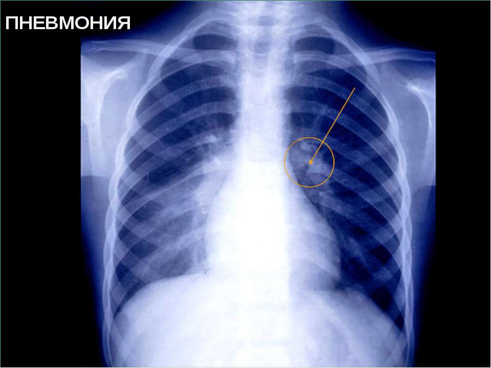 Обструктивная пневмония: причины, симптомы и диагностика. лечение пневмонии в москве