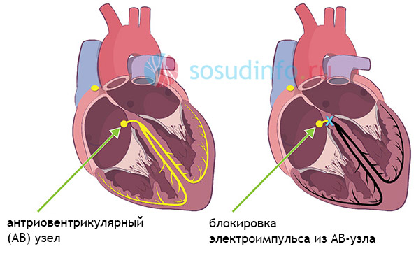 Блокада сердца 1 степени: причины, симптоматика и лечение
