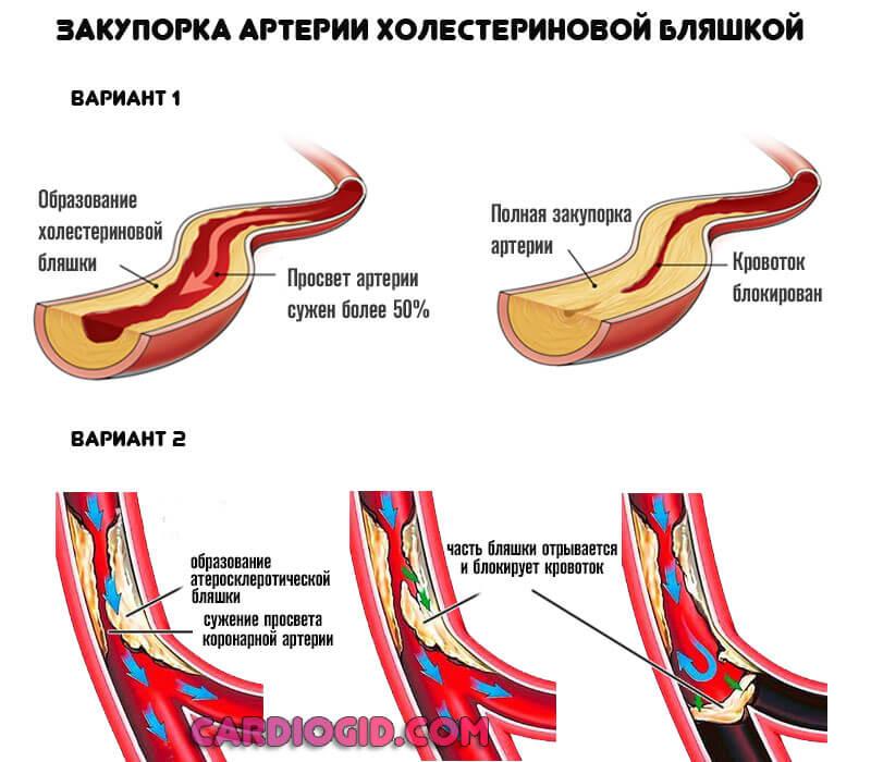 Что такое обширный инфаркт сердца и его последствия