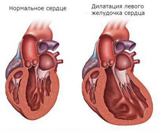 Дилатация желудочков сердца
