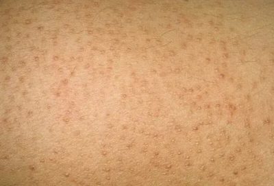 Эластоз кожи, солнечный и актинический: симптомы и лечение эластоза