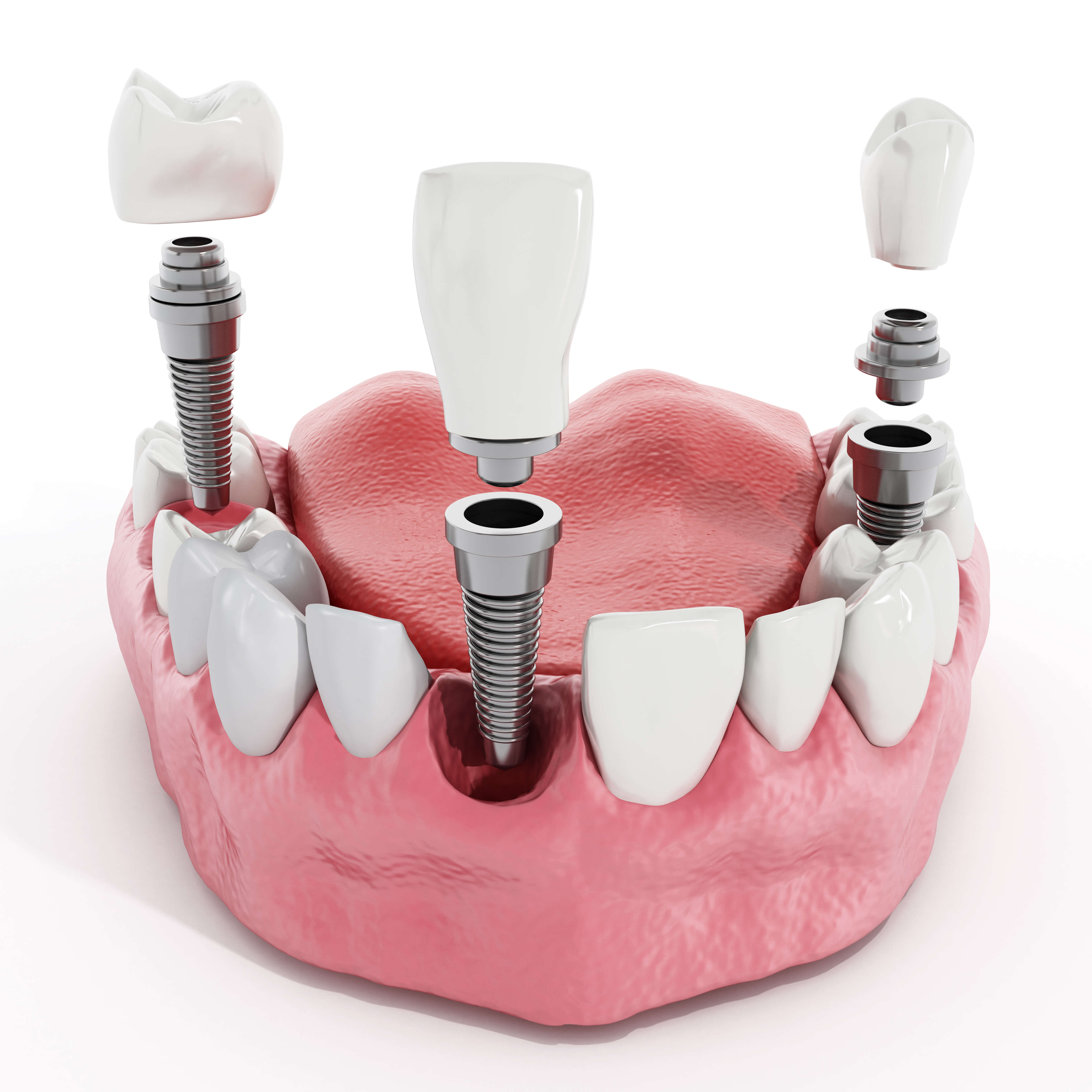 Виды имплантов зубов — какие бывают зубные имплантанты