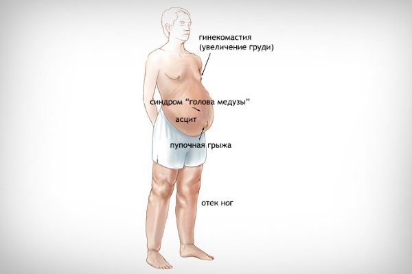 Синдром портальная гипертензия при циррозе печени, центр лечения