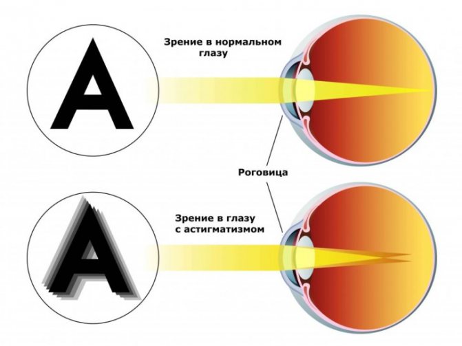 Астигматизм у детей