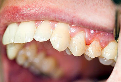 Лечение кариеса — как лечат заболевание зубов у стоматолога