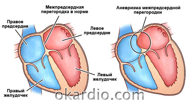 Причины, симптомы и лечение открытого овального окна у грудничка