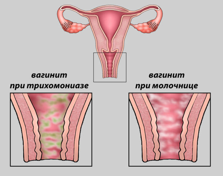 Болезнь женщин, мужчин и детей: молочница (вагинальный кандидоз)