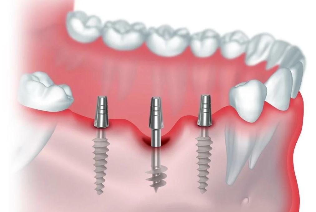 Виды имплантов зубов и их производители — какие бывают зубные имплантанты?