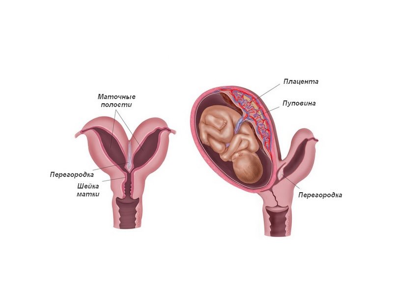 Двурогая матка при беременности в левом, в правом роге, что это такое, плохо ли это
