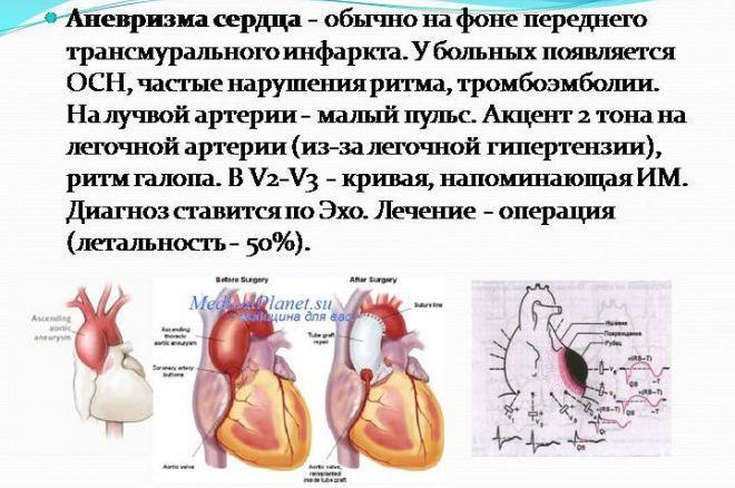Аневризма аорты сердца что это такое симптомы - здоров.сердцем
