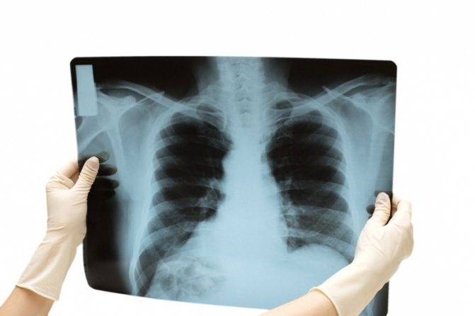 Флюорография и рентген легких в медицине, в чем разница и отличие