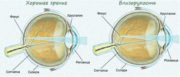 Степени миопии: высокая, средняя и слабая степени миопии глаза (близорукость 1, 2 и 3 степени)